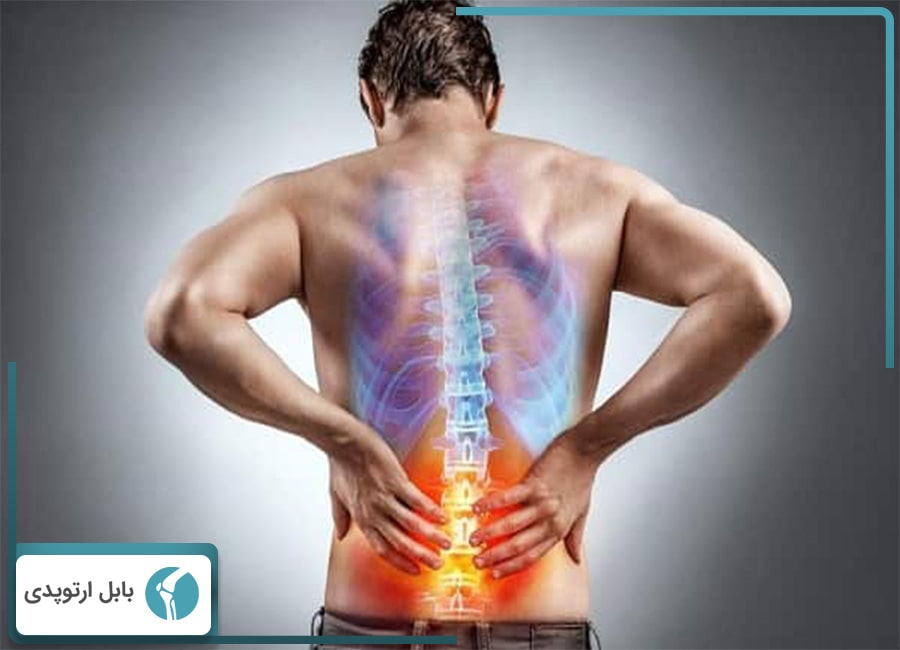 بیرون زدگی دیسک کمر