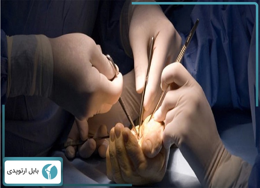 آرتروسکوپی مچ دست در بابل