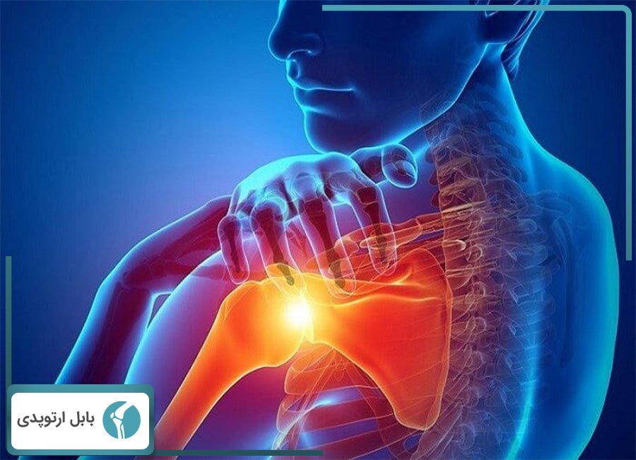 سندروم گیرافتادگی شانه